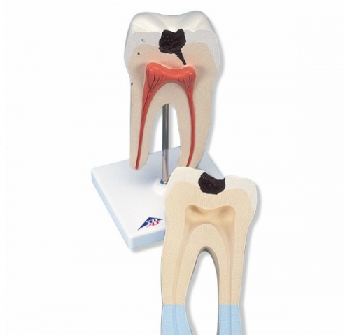 하악 대구치 충치 모형, 2파트 Lower Twin-Root Molar showing cavities, 2 part D10/4